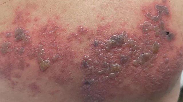 大人小孩都会得的带状疱疹，治不好还会有后遗症，我国超3亿人正在遭受慢性疼痛(图2)