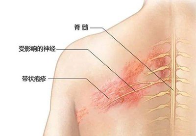 吕一抹带状疱疹通络粉,不吃药、不打针、不针灸、只需热敷就能缓解给您带来的困扰?选对产品,事半功倍!(图3) 吕一抹带状疱疹通络粉,不吃药、不打针、不针灸、只需热敷就能缓解给您带来的困扰?选对产品,事半功倍!(图3)