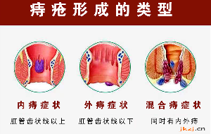 十男九痣，十女十痔得了痔疮坐立难安，吕易圣痔疮灵，无需微创只需一洗一抹(图1)