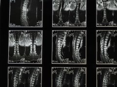 中医辅助调理脊髓炎：3个核心方法提升恢复效果 - 深圳健康科普资讯网