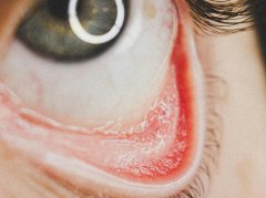 红眼病发作？5个穴位可辅助缓解眼部不适 - 深圳健康科普资讯网