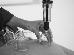 拔罐无最佳时间？找准适应症避开禁忌是关键 - 深圳健康科普资讯网