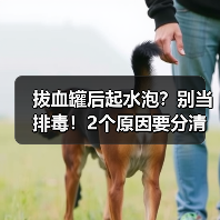 拔血罐后起水泡？别当排毒！2个原因要分清(图2)
